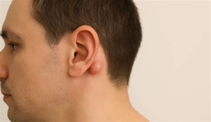 Cillian Murphy: Insight Into A Mysterious Lump Behind His Right Ear