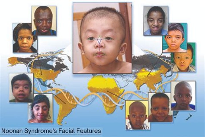 Discover Famous Figures With Noonan Syndrome