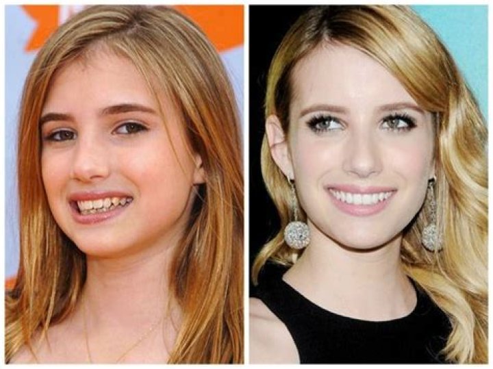 Emma Roberts Plastic Surgery | Before And After