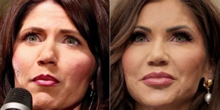 New Kristi Noem's Plastic Surgery Transformation: Before And After Pictures Revealed