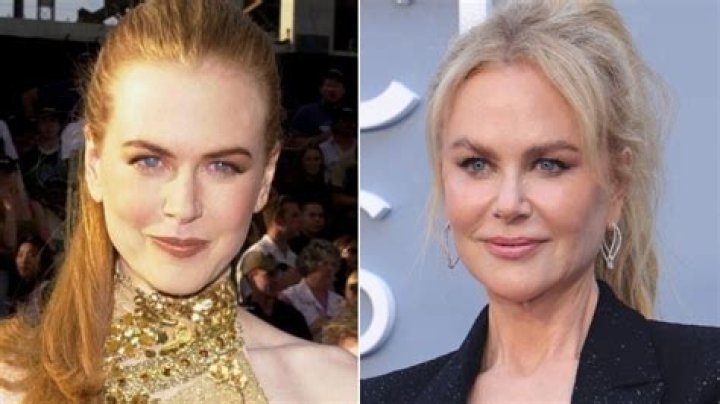 Plastic Surgery Secrets Of Nicole Kidman: The Ultimate Transformation
