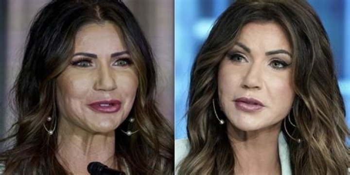 Stunning Transformation: Kristi Noem's Plastic Surgery Journey
