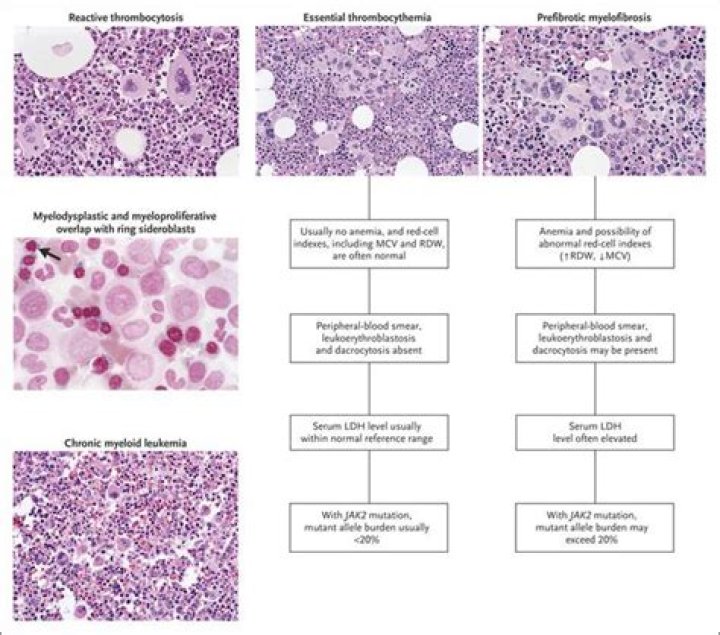 The Famous Faces Of Essential Thrombocythemia