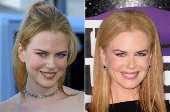 The Unveiled Truth: Nicole Kidman's Plastic Surgery Journey