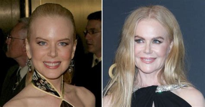 Uncovering The Transformative Journey: Nicole Kidman's Cosmetic Surgery Revelations